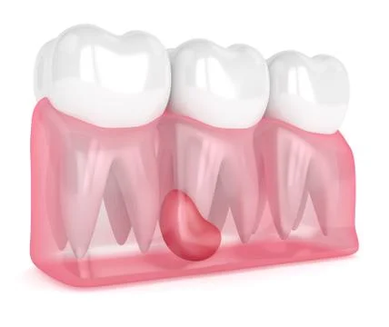 3d render of teeth in gums with cyst Stockillustratie