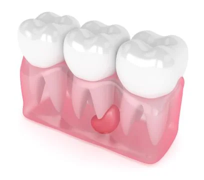 3d render of teeth in gums with cyst Stockillustratie