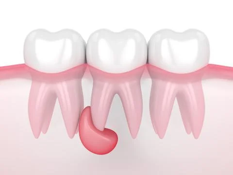 3d render of teeth in gums with cyst Illustrazione stock