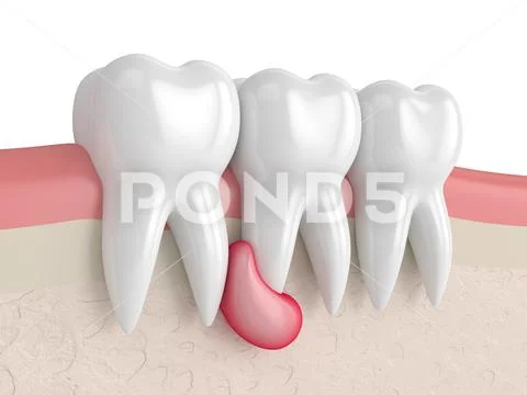 3d render of teeth in gums with cyst: Royalty Free #131512770