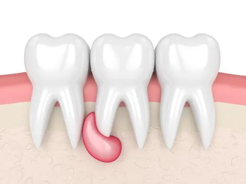 3d render of teeth in gums with cyst Stock Illustration