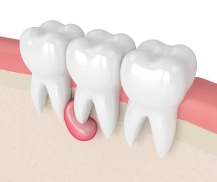 3d render of teeth in gums with cyst Stock Illustration
