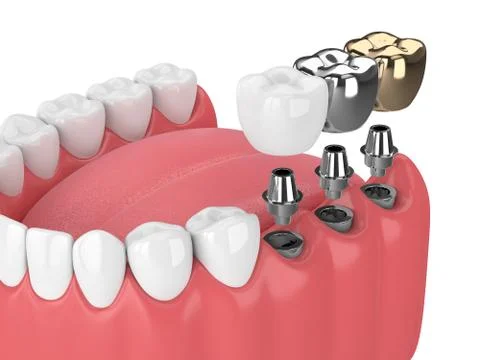 3d render of teeth with implants Stock Photos
