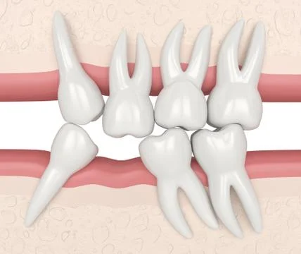 3d render of teeth sliding towards the area of missing tooth in order to fill 스톡 일러스트