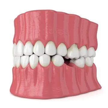 3d render of teeth sliding towards the area of missing tooth in order to fill Illustrazione stock