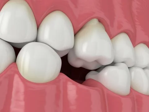 3d render of teeth sliding towards the area of missing tooth in order to fill Stock Photos