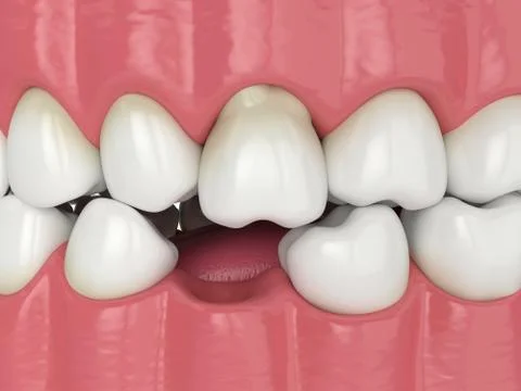 3d render of teeth sliding towards the area of missing tooth in order to fill Stock Photos