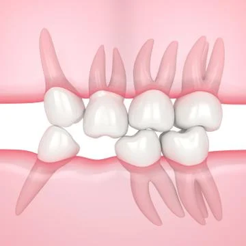 3d render of teeth sliding towards the area of missing tooth in order to fill Stock Photos