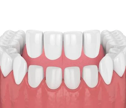 3d render of teeth with veneers Stock Illustration
