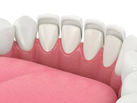 3d render of teeth with veneers Stock Illustration
