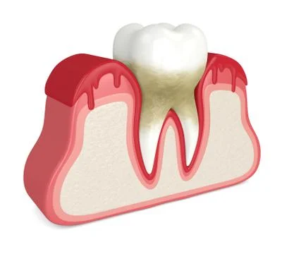 3d render of tooth in bleeding gums Stock Illustration