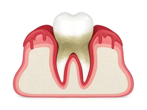 3d render of tooth in bleeding gums Illustrazione stock