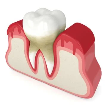3d render of tooth in bleeding gums Stock Illustration
