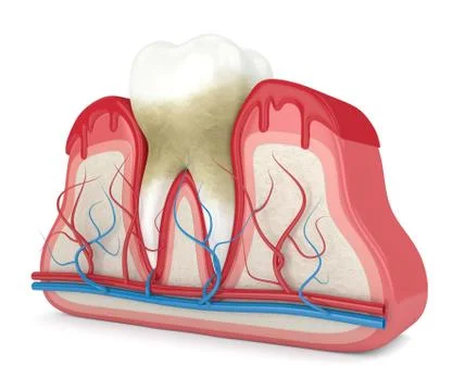 3d render of tooth in bleeding gums Illustrazione stock