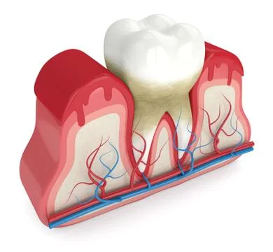 3d render of tooth in bleeding gums Stock Illustration