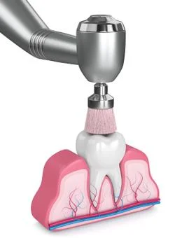 3d render of tooth with dental handpiece and polishing brush Stock Illustration
