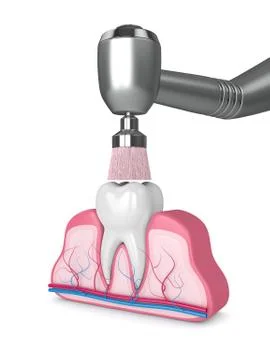 3d render of tooth with dental handpiece and polishing brush Stock Illustration
