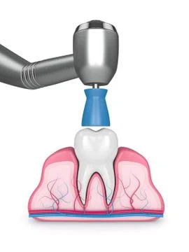 3d render of tooth with dental handpiece and polishing prophy cup Illustrazione stock