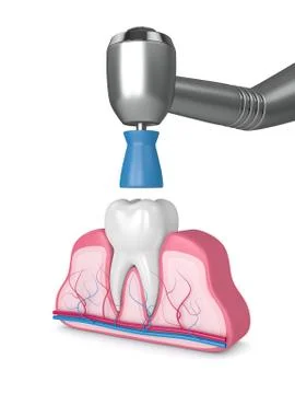 3d render of tooth with dental handpiece and polishing prophy cup Stock Illustration