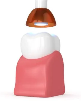 3d render of tooth with dental polymerization lamp and light cured inlay 스톡 사진