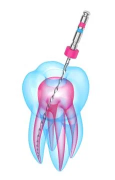 3d render of tooth with endodontic file over white background Illustrazione stock