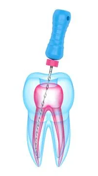 3d render of tooth with endodontic file over white background Stock Illustration