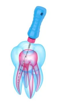 3d render of tooth with endodontic file over white background Stock Illustration