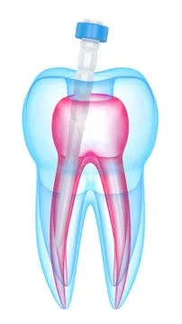 3d render of tooth with fiber post over white Stock Illustration