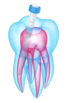 3d render of tooth with fiber post over white Stock Illustration