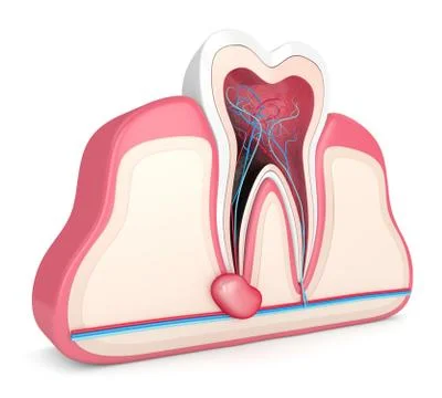 3d render of tooth in gums with cyst Illustrazione stock