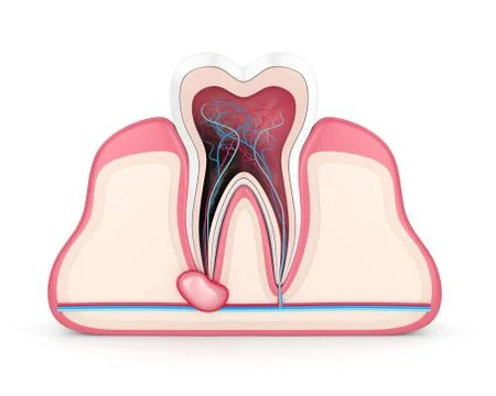 3d render of tooth in gums with cyst Stock Illustration