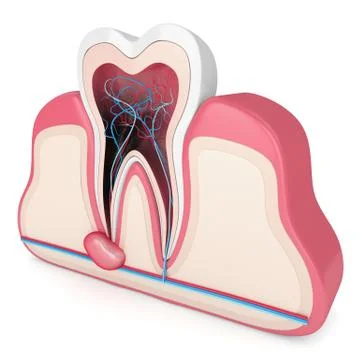 3d render of tooth in gums with cyst Stock Illustration