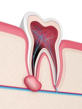 3d render of tooth in gums with cyst Illustrazione stock