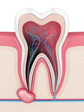 3d render of tooth in gums with cyst Stock Illustration