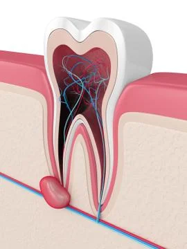 3d render of tooth in gums with cyst Stock Illustration
