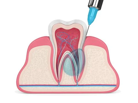 3d render of tooth in gums with intraligamentary anesthesia procedure Stock Illustration