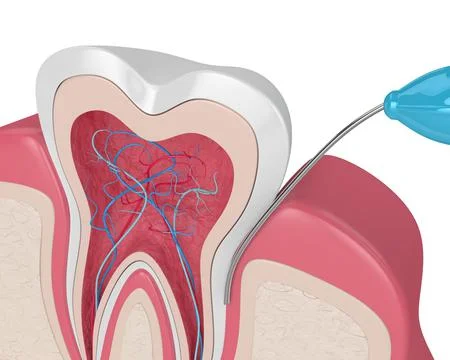 3d render of tooth in gums with intraligamentary anesthesia procedure Stock Illustration