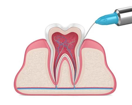 3d render of tooth in gums with intraligamentary anesthesia procedure Illustrazione stock