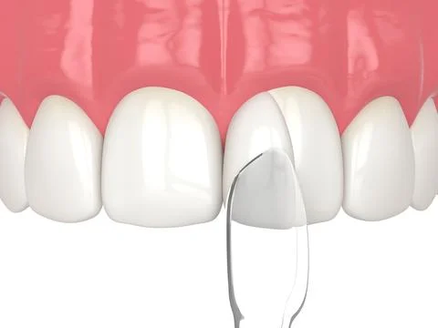 3d render of tooth reshaped by composite resin adm matrix over white. Stock Illustration