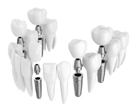 3d render of toothing with dental implants Stock Illustration