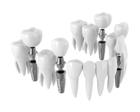 3d render of toothing with dental implants Stock Illustration
