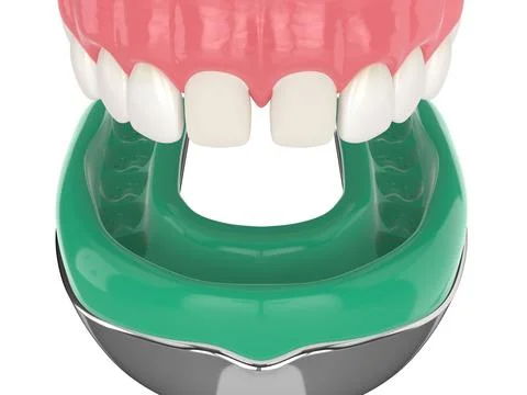 3d render of upper jaw with dental impression tray Stock Photos