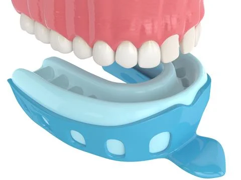 3d render of upper jaw with dental impression tray Stock Photos