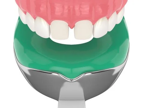 3d render of upper jaw with dental impression tray Stock Photos
