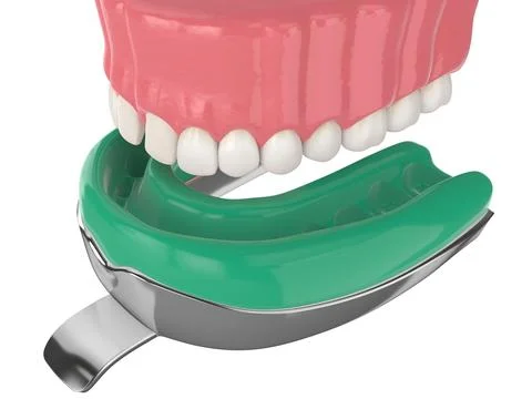 3d render of upper jaw with dental impression tray Stock Photos