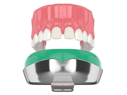 3d render of upper jaw with dental impression tray Stock Photos