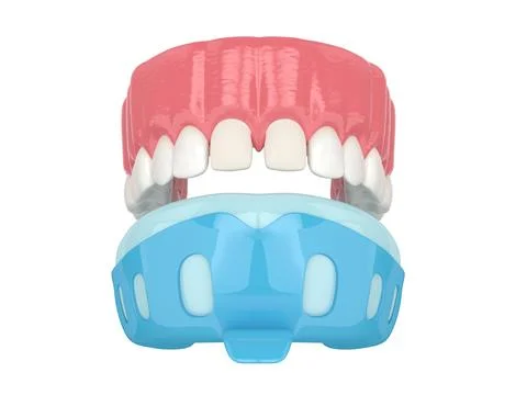 3d render of upper jaw with dental impression tray Stock Photos