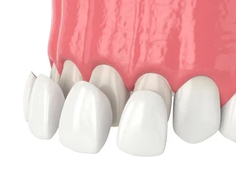 3d render of upper jaw with four veneers Stock Illustration