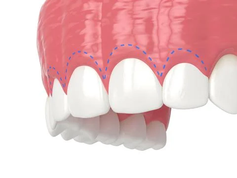 3d render of upper jaw with gummy smile and corrected gum line. Illustrazione stock