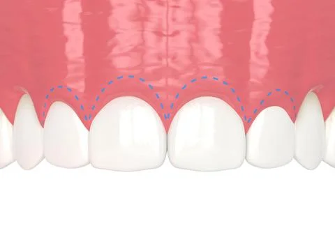 3d render of upper jaw with gummy smile and corrected gum line. Stock Illustration